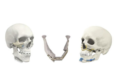 Craniomaxillofacial | Stryker
